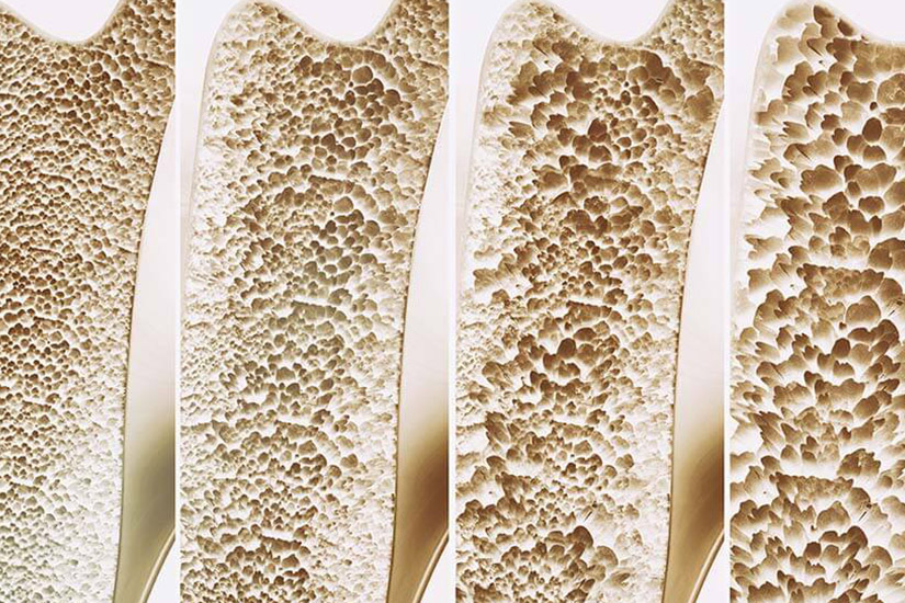 Knochenschwung aufgrund von Osteoporose.
