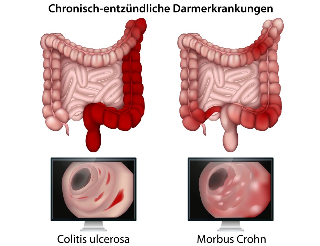 Chronisch entzündliche Darmerkrankungen